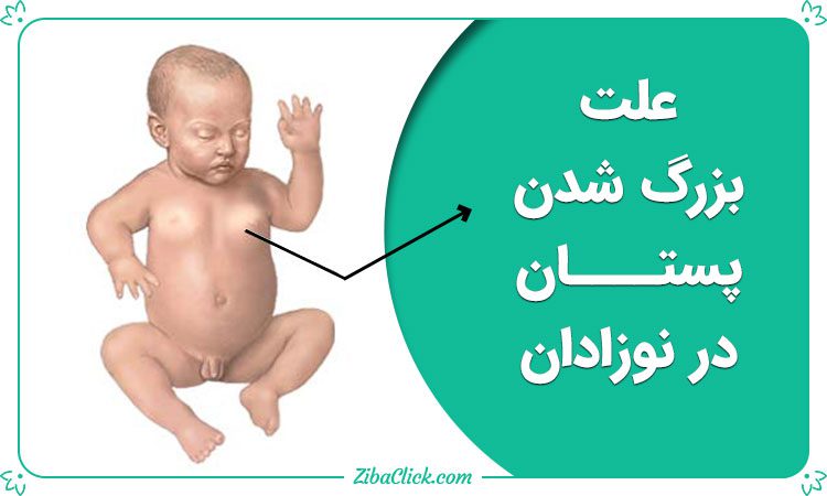 علت بزرگ شدن پستان در نوزادان