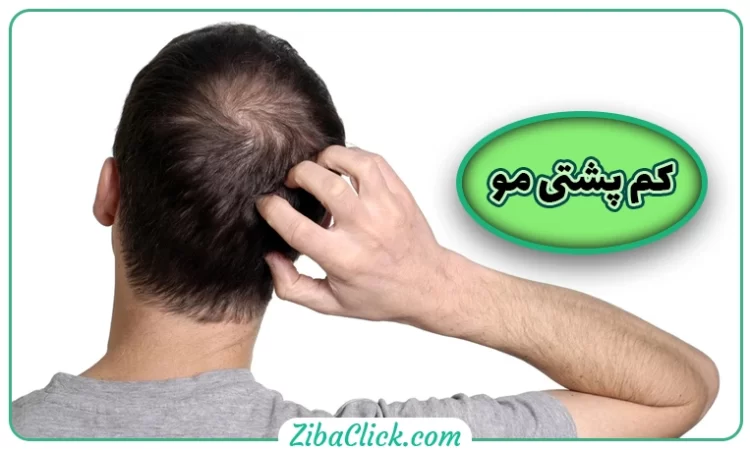 کم پشتی مو سر: علت، علائم و نشانه های آن