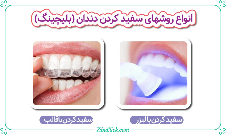 انواع روش سفید کردن دندان