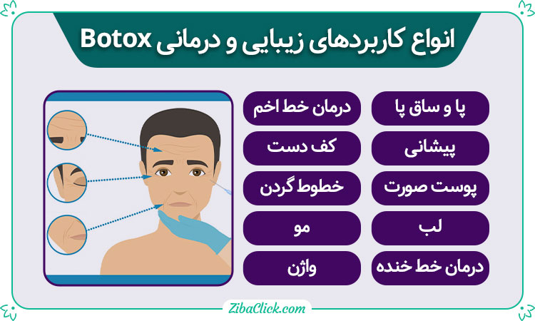 کاربرد botox