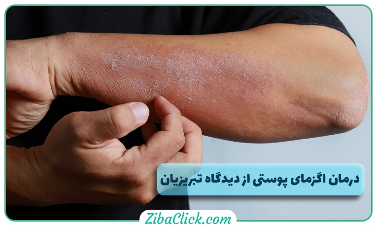 traditional medicine in the treatment of eczema
