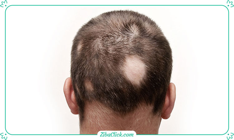 آلوپسی یکی از دلایل کم پشت شدن موهاست.