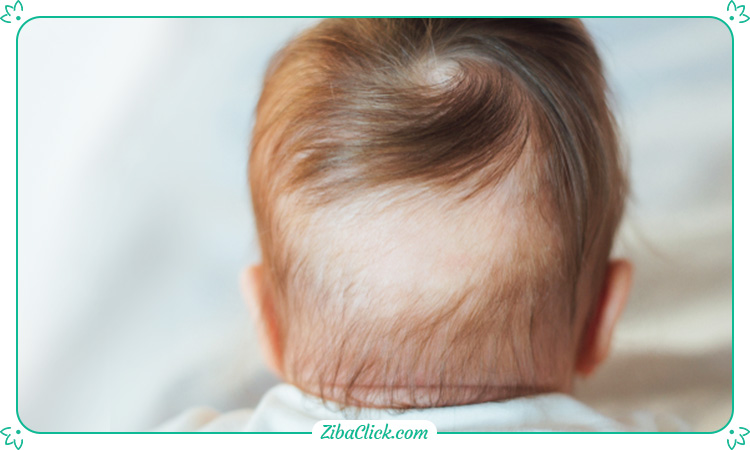 کم پشتی مو در کودکان اغلب موقتی است.