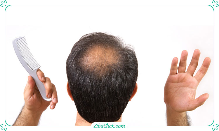 با تغییر در رژیم غذایی و دریافت انواع ویتامین ها می توان از نازکی مو سر پیشگیری کرد.