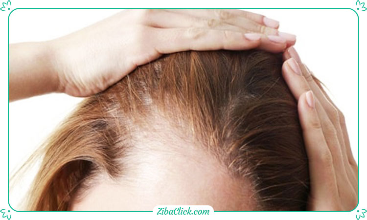 دلایل زیادی مانند تغییرات هورمونی، زایمان، استرس و... باعث ایجاد تار موی نازک در زنان می‌شود