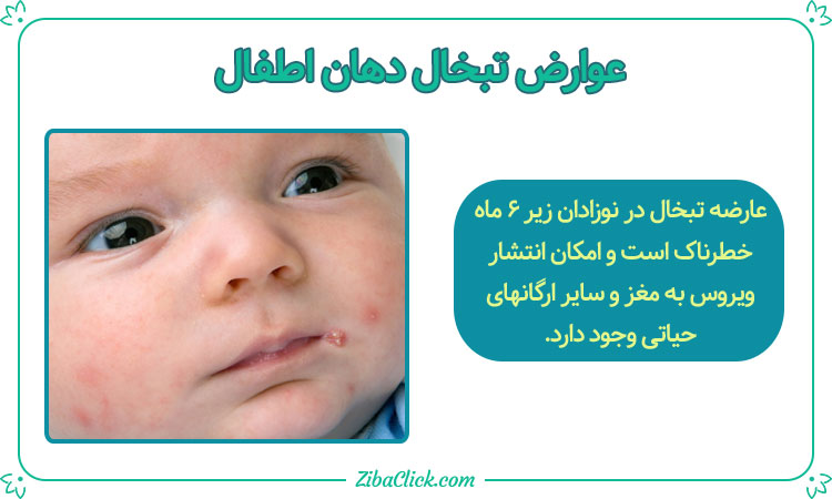 عوارض تبخال دهان اطفال