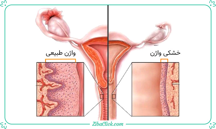 علائم خشکی واژن