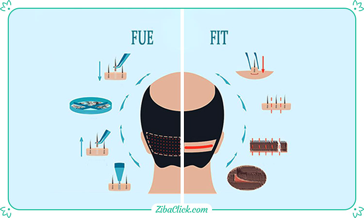 مراحل انجام کاشت مو در روش FIT