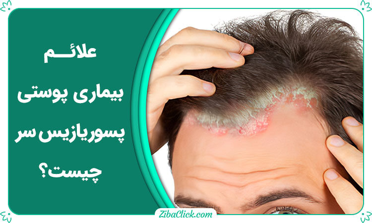 علائم بیماری پوستی پسوریازیس سر چیست؟