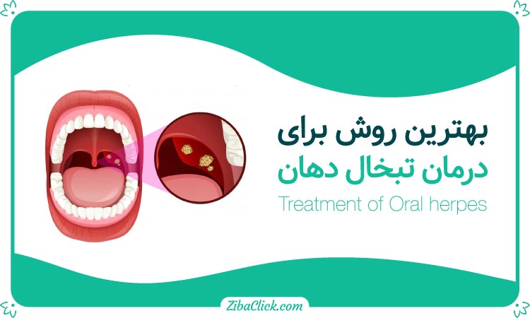 موثرترین روش های درمان تبخال دهان