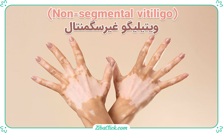 پیسی غیرسگمنتال (Non-segmental vitiligo)
