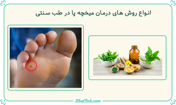 درمان میخچه پا در طب سنتی