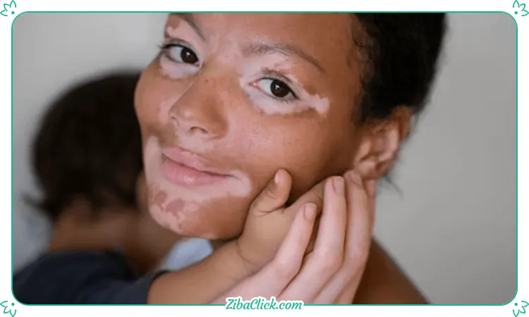 Diet for the treatment of vitiligo 5