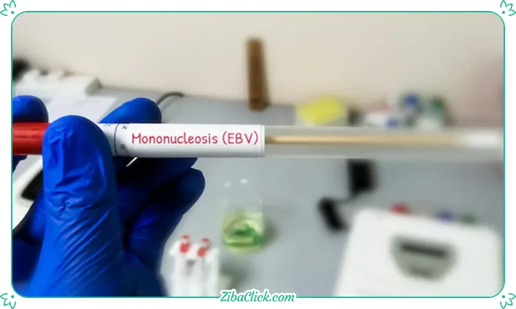 بیماری مونونوکلئوز عفونی (بیماری بوسه) و درمان آن